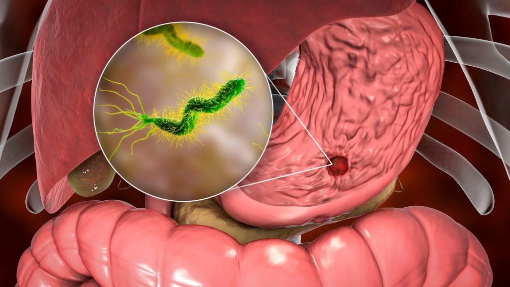 ¿Helicobacter pylori? ¡Cuidado! Tu estómago está en&nbsp;riesgo