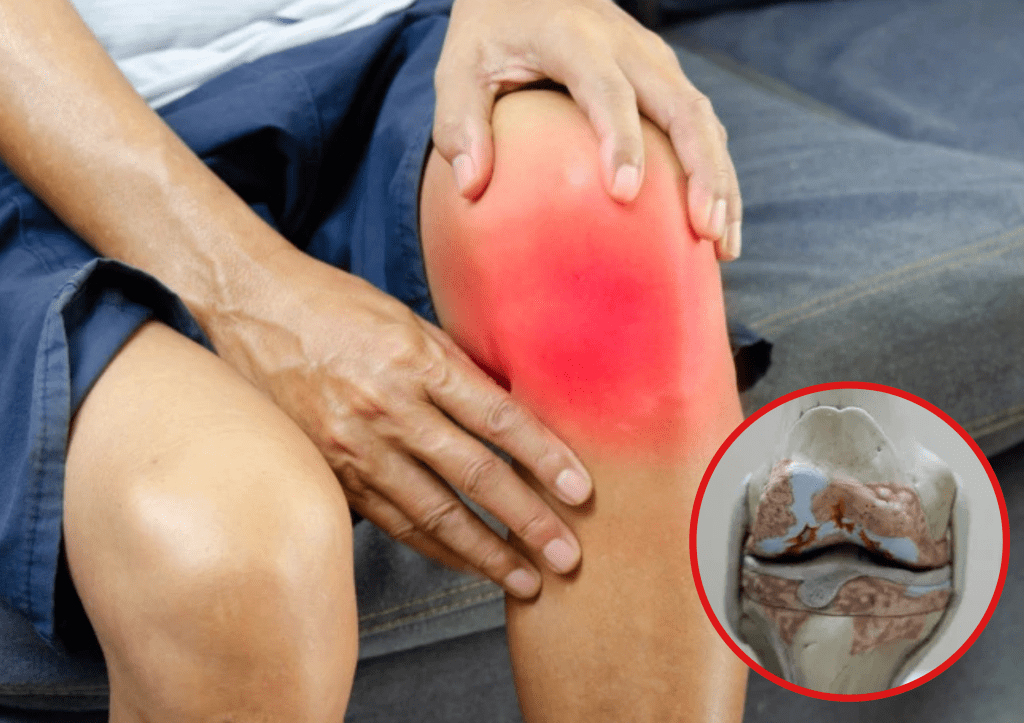 ¿Sufres Gonartrosis? el Ácido Hialurónico es para&nbsp;ti