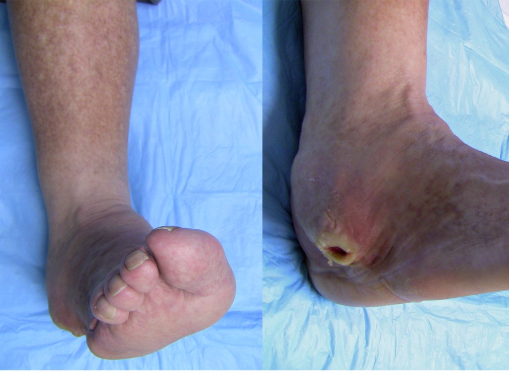 ¿Sufres de Pie Diabético? ozono y oxigenoterapia son la&nbsp;solución