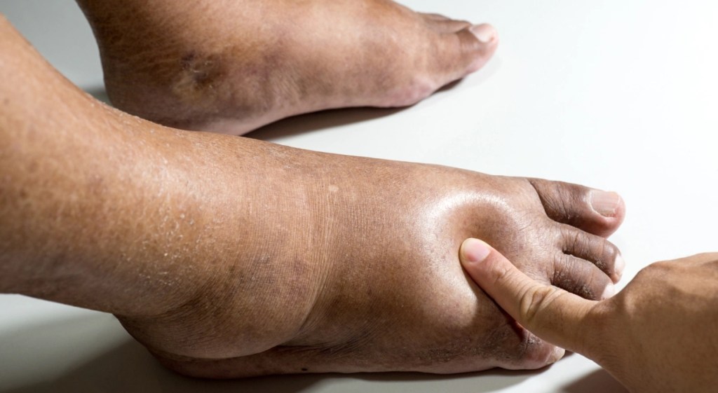 ¿Piernas y pies inflamados? debes visitar al&nbsp;cardiólogo