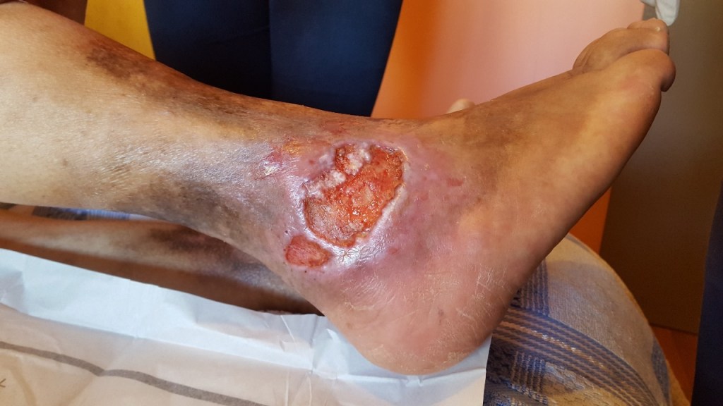 Cuando la circulación falla, la piel sufre: La úlcera&nbsp;varicosa