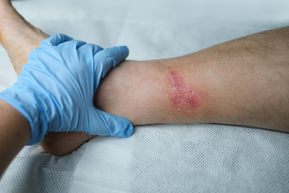 ¿Heridas crónicas que no sanan? No son “heridas simples”, son señales de&nbsp;alerta